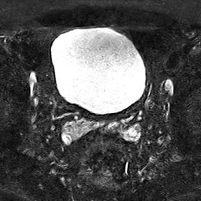File:Normal prostate (MRI) (Radiopaedia 29986-30535 Axial STIR 22).jpg