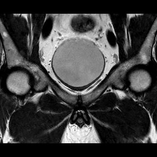 File:Normal prostate (MRI) (Radiopaedia 29986-30535 Coronal T2 4).jpg