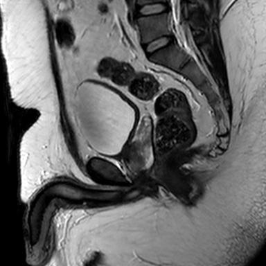 File:Normal prostate (MRI) (Radiopaedia 29986-30535 Sagittal T2 10).jpg
