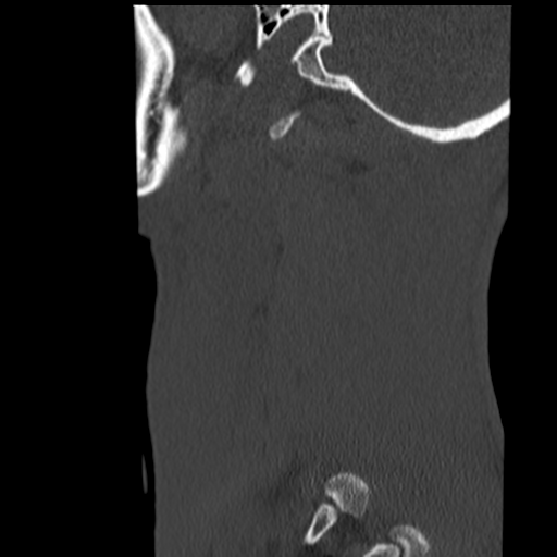 File:Normal trauma cervical spine (Radiopaedia 41017-43760 Sagittal bone window 47).png