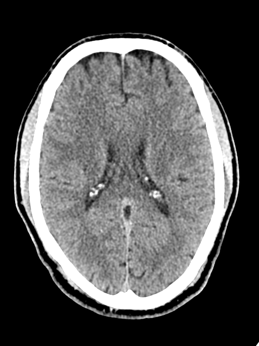 Normal trauma protocol brain and C-spine CT (Radiopaedia 83302-97709 Axial non-contrast 34).jpg