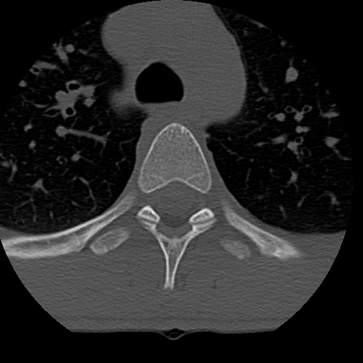 Normal trauma spine imaging (age 16) (Radiopaedia 45335-49358 Axial bone window 105).jpg