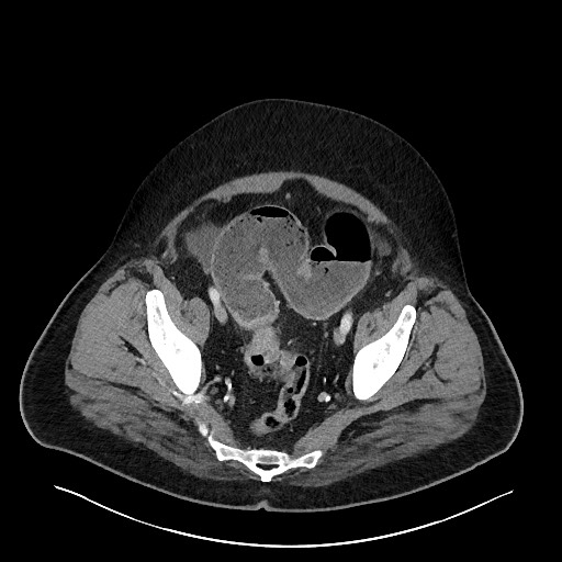 Obstructing sigmoid adenocarcinoma (Radiopaedia 58465-65619 A 138).jpg