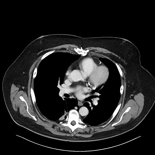 Obstructing sigmoid adenocarcinoma (Radiopaedia 58465-65619 A 2).jpg