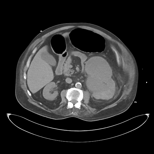 File:Obstructive pyelonephritis (Radiopaedia 46411-50844 Axial non-contrast 33).png