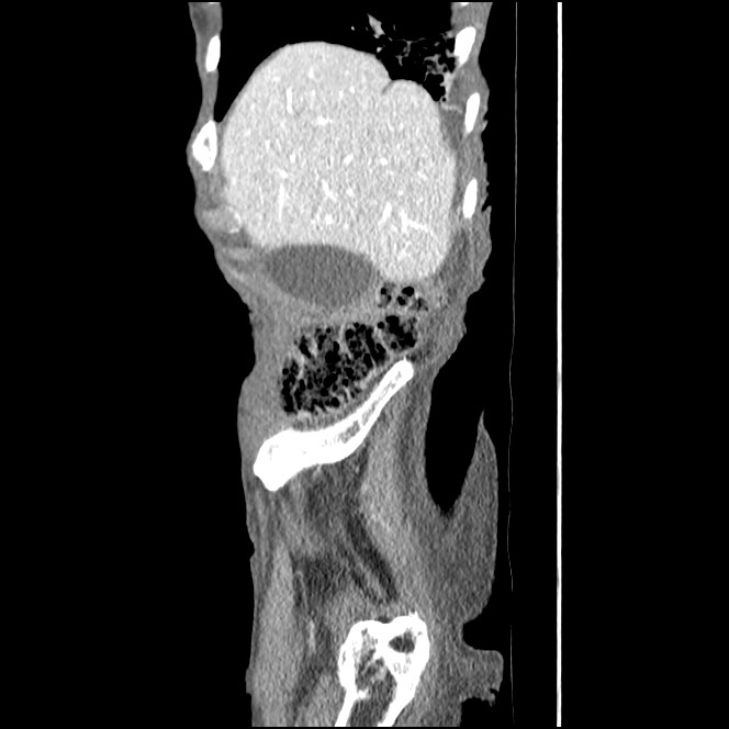 Obturator hernia causing small bowel obstruction (Radiopaedia 65522-74612 C 85).jpg