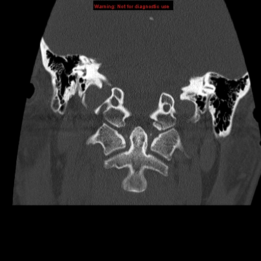 File:Occipital condyle fracture (Radiopaedia 18366-18208 Coronal bone window 8).jpg