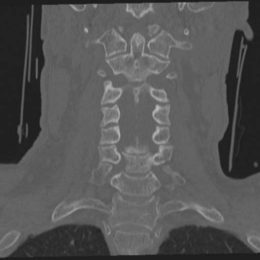 File:Occipital condyle fracture (Radiopaedia 33467-34517 Coronal bone window 30).png