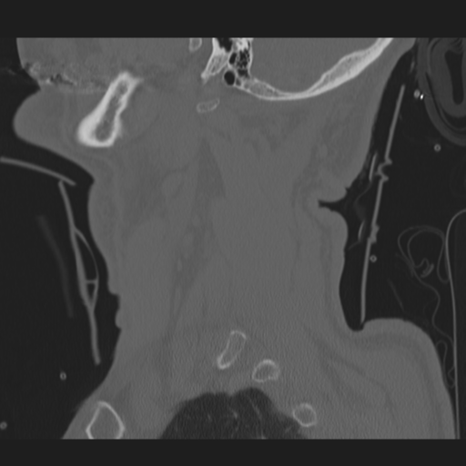 File:Occipital condyle fracture (Radiopaedia 33467-34517 Sagittal bone window 7).png