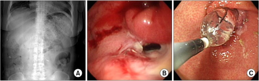 a-c)Radiologic and endoscopic finding of delayed gastric emptying