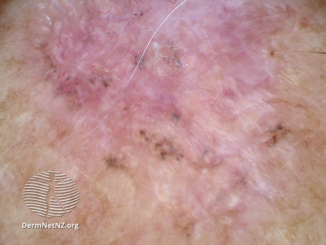 File:Perpendicular white lines, blue globule, leaf-like structures in pigmented basal cell carcinoma dermoscopy (DermNet NZ pbcc-arm-dn).jpg