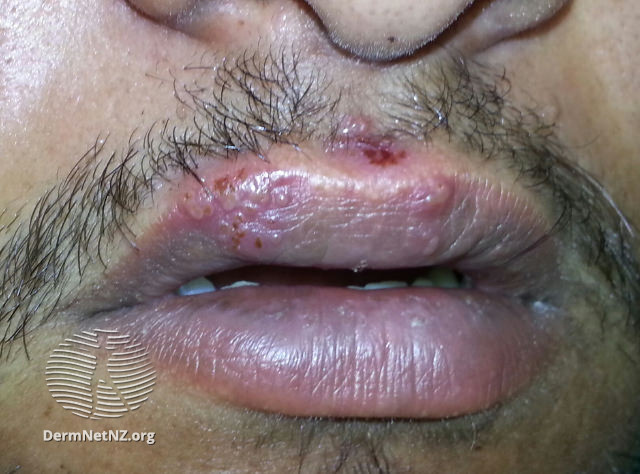 File:(DermNet NZ herpes-simplex-labialis-23).jpg