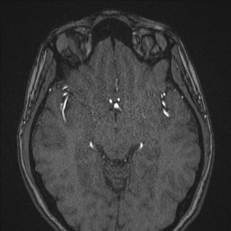A1 segment hypoplasia (Radiopaedia 83365-97781 Axial TOF MRA 88).jpg