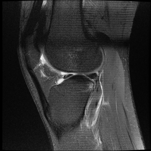 File:ACL acute full thickness tear - deep lateral femoral sulcus sign (Radiopaedia 38594-40740 Sagittal PD fat sat 15).jpg