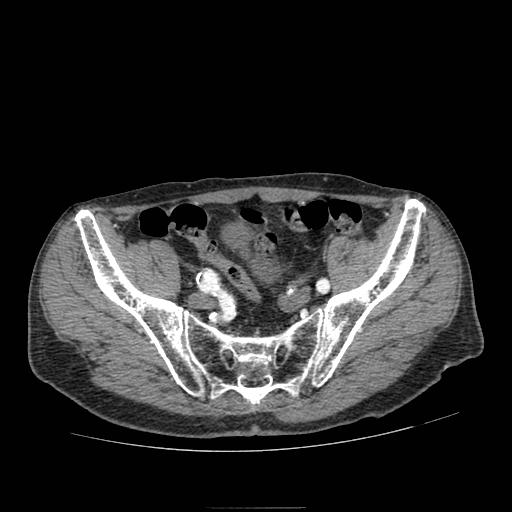 Abdominal aortic aneurysm (Radiopaedia 13341-13340 Axial C+ arterial phase 201).jpg