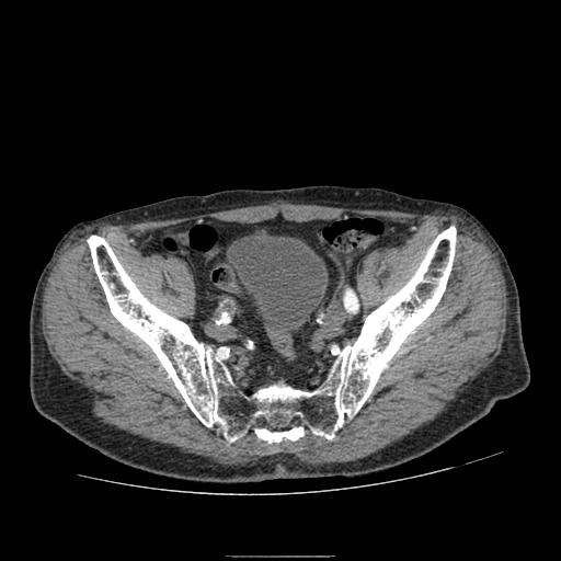 Abdominal aortic aneurysm (Radiopaedia 13341-13340 Axial C+ arterial phase 208).jpg