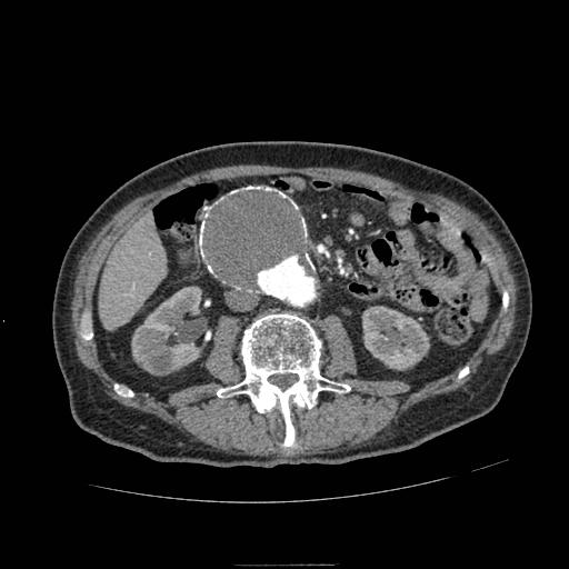 File:Abdominal aortic aneurysm (Radiopaedia 13341-13340 Axial C+ arterial phase 95).jpg