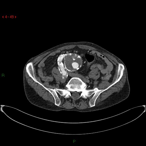 File:Abdominal aortic aneurysm (Radiopaedia 16155-15834 Axial C+ arterial phase 29).jpg