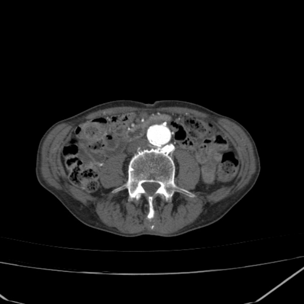 Abdominal aortic aneurysm (Radiopaedia 23703-23856 Axial C+ arterial phase 51).jpg
