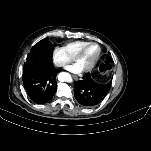 File:Abdominal aortic aneurysm (Radiopaedia 67117-76452 Axial C+ arterial phase 10).jpg