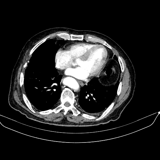 Abdominal aortic aneurysm (Radiopaedia 67117-76452 Axial C+ arterial phase 9).jpg