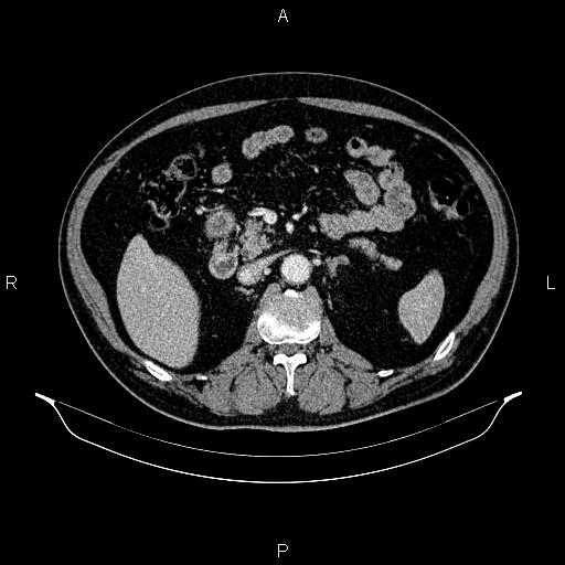 Abdominal aortic aneurysm (Radiopaedia 83094-97462 Axial renal cortical phase 88).jpg