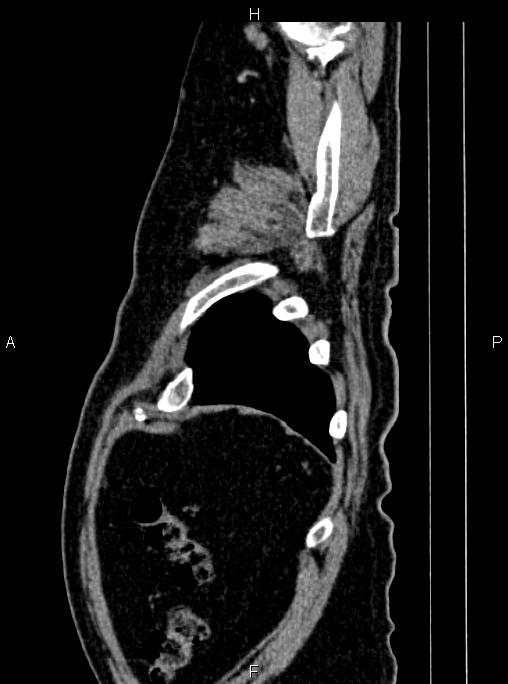 Abdominal aortic aneurysm (Radiopaedia 83094-97462 Sagittal renal cortical phase 114).jpg