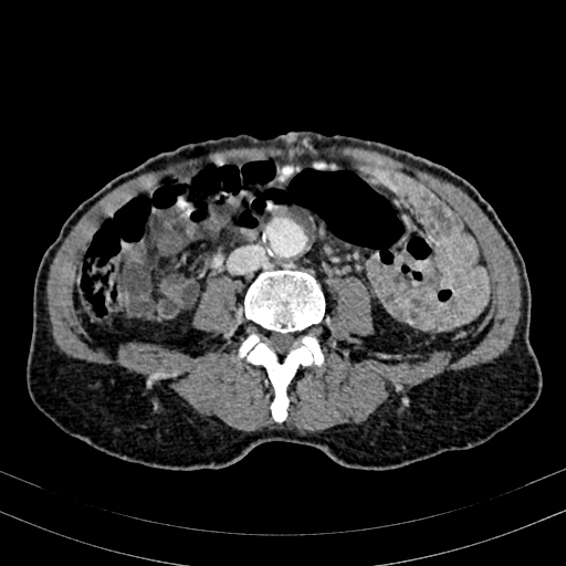 Abdominal aortic aneurysm (Radiopaedia 83581-98689 Axial C+ portal venous phase 65).jpg