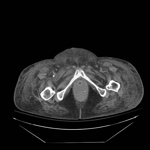 File:Abdominal aortic aneurysm - impending rupture (Radiopaedia 19233-19247 Axial non-contrast 173).jpg