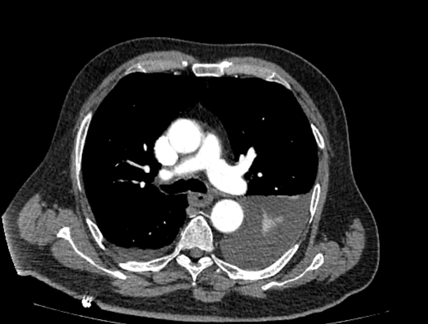 Abdominal aortic aneurysm rupture (Radiopaedia 54179-60362 Axial C+ arterial phase 8).jpg