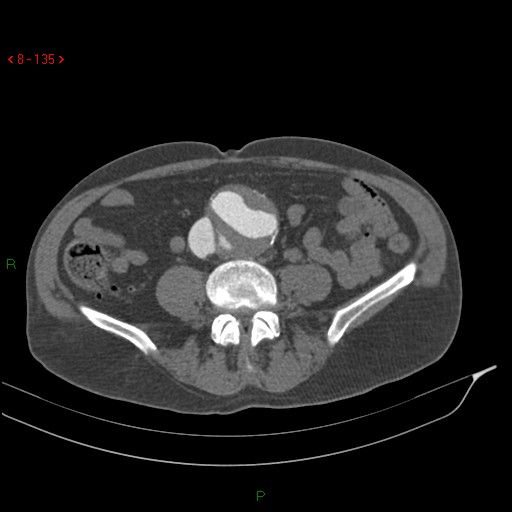 File:Abdominal aortic aneurysm rupture with aortocaval fistula (Radiopaedia 14897-14841 Axial C+ arterial phase 135).jpg