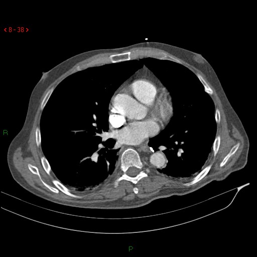 Abdominal aortic aneurysm rupture with aortocaval fistula (Radiopaedia 14897-14841 Axial C+ arterial phase 38).jpg