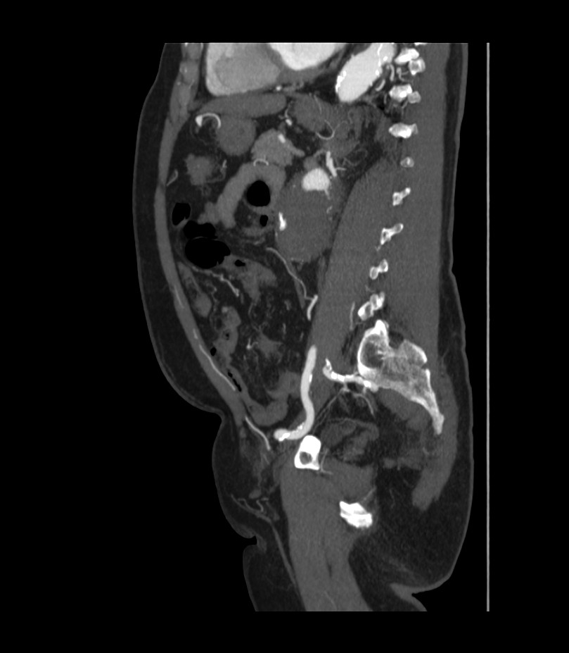 Abdominal aortic aneurysm with thrombus fissuration (Radiopaedia 46218-50618 Sagittal C+ arterial phase 37).jpg
