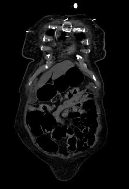 Abdominal aortic aneurysm with thrombus fissuration (Radiopaedia 73192-83919 Coronal C+ arterial phase 1).jpg