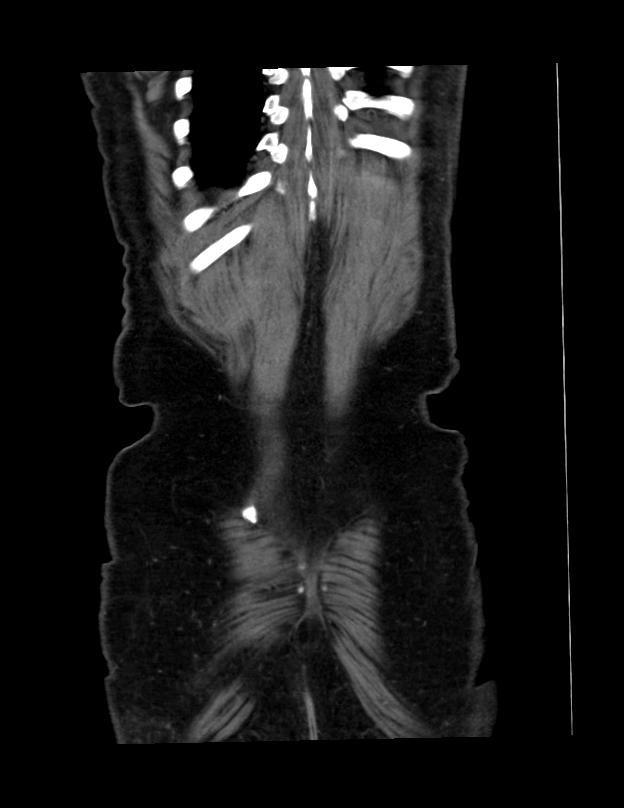 Abdominal lymphoma - with sandwich sign (Radiopaedia 53486-59492 C+ portal venous phase 3).jpg
