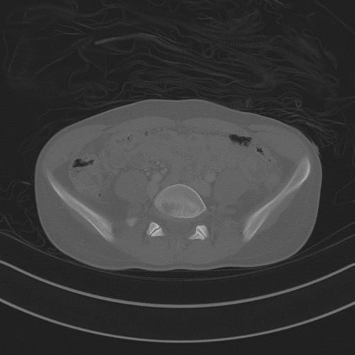 Abdominal multi-trauma - devascularised kidney and liver, spleen and pancreatic lacerations (Radiopaedia 34984-36486 Axial bone window 56).png