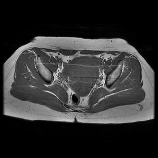 File:Abdominal wall endometriosis (Radiopaedia 83702-98847 Axial T1 9).jpg