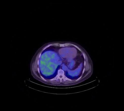 Abdominal wall metastasis from colorectal carcinoma (Radiopaedia 31016-31719 Axial 94).jpg