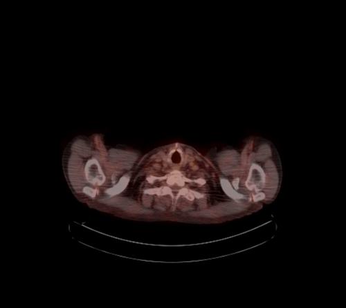 Abdominal wall metastasis from colorectal carcinoma (Radiopaedia 31016-31719 C 130).jpg