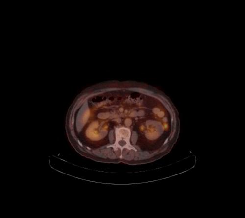 Abdominal wall metastasis from colorectal carcinoma (Radiopaedia 31016-31719 C 69).jpg