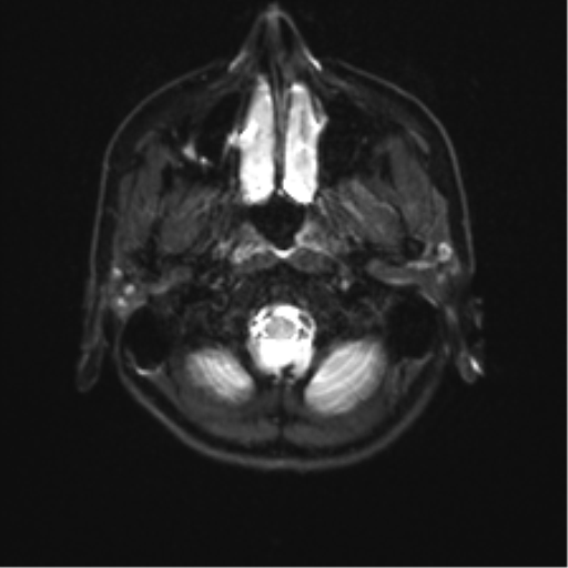 File:Abducens nerve palsy (Radiopaedia 51069-56648 Axial DWI 1).png