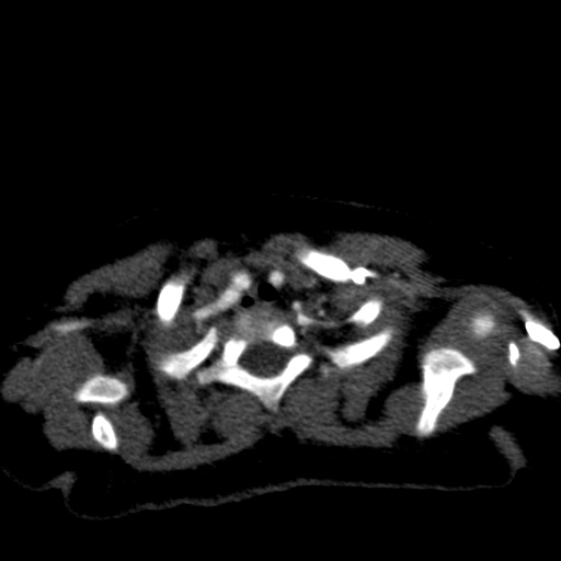 Aberrant left pulmonary artery (pulmonary sling) (Radiopaedia 42323-45435 Axial C+ CTPA 6).jpg