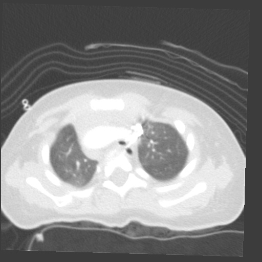 File:Aberrant left pulmonary artery (pulmonary sling) (Radiopaedia 42323-45435 Axial lung window 9).jpg