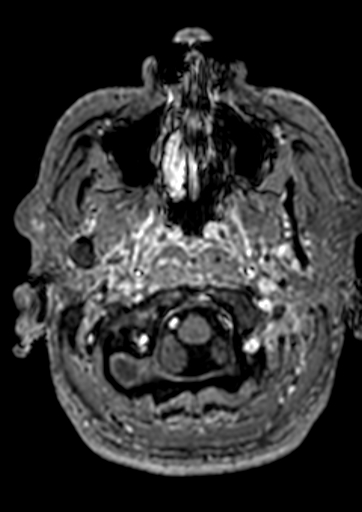 File:Accessory middle cerebral artery (Radiopaedia 73114-83828 Axial T1 C+ 184).jpg