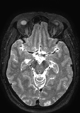 Accessory middle cerebral artery (Radiopaedia 73114-83828 Axial T2 108).jpg