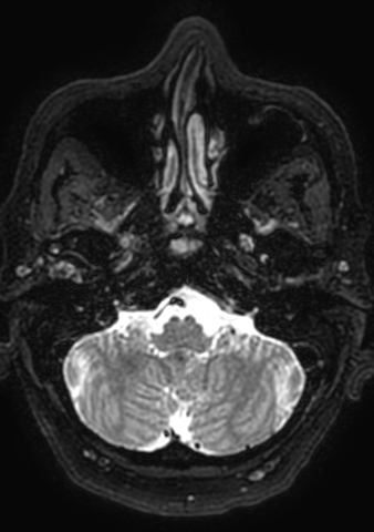 Accessory middle cerebral artery (Radiopaedia 73114-83828 Axial T2 186).jpg