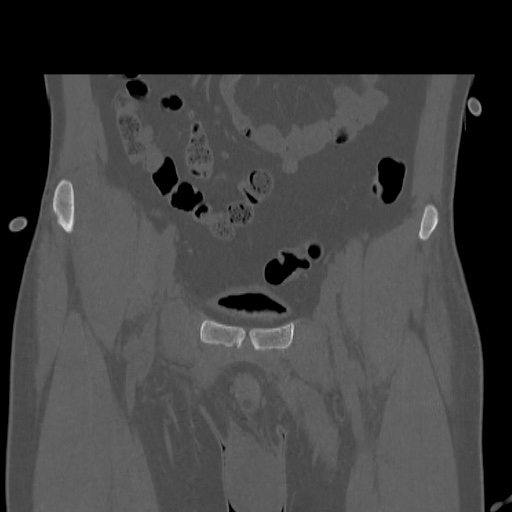 Acetabular and ilial fractures (Radiopaedia 59084-66378 Coronal bone window 11).jpg