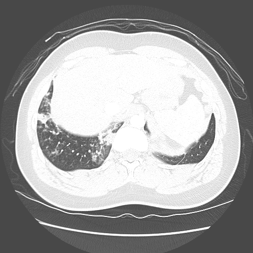 Achalasia (Radiopaedia 52507-58417 Axial lung window 57).jpg
