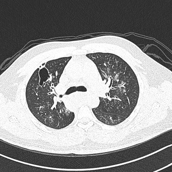 Achalasia with aspiration (Radiopaedia 55413-61845 Axial lung window 25).jpg