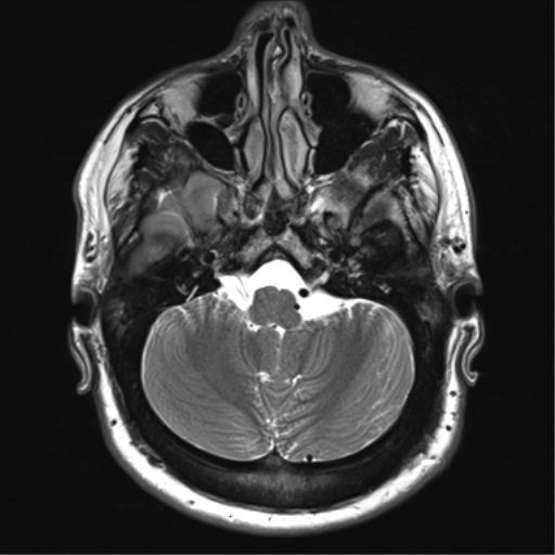 File:Achondroplasia (Radiopaedia 65109-74105 Axial T2 6).png